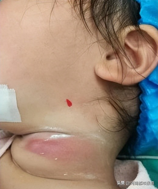 喉咙长了个小洞,喉咙里长了一个小泡要不要扎破