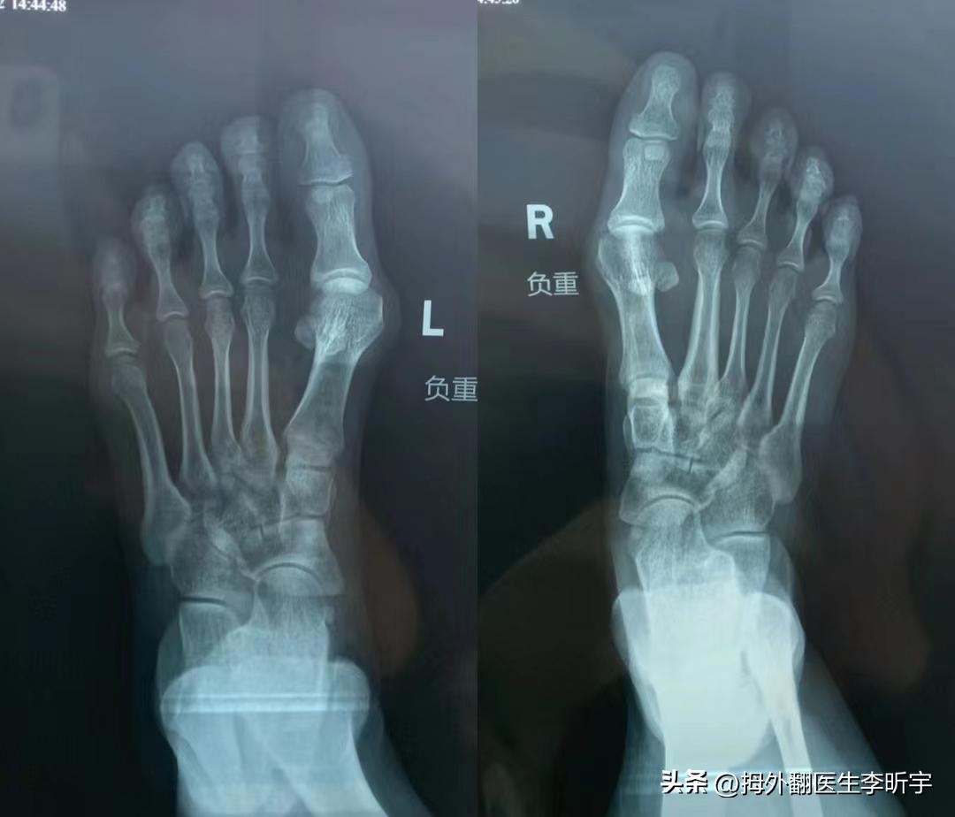 遗传拇外翻最好的恢复方法,4岁女孩遗传拇外翻能治吗