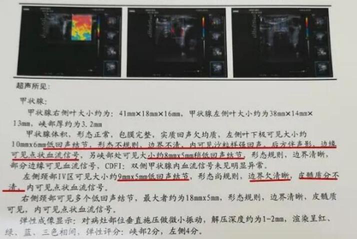 甲状腺结节往下移了可以做消融吗,甲状腺结节恶变了严重吗