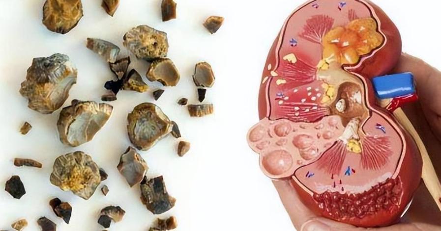 肾结石是什么病，治疗不及时会发生什么？术后护理需要注意些什么