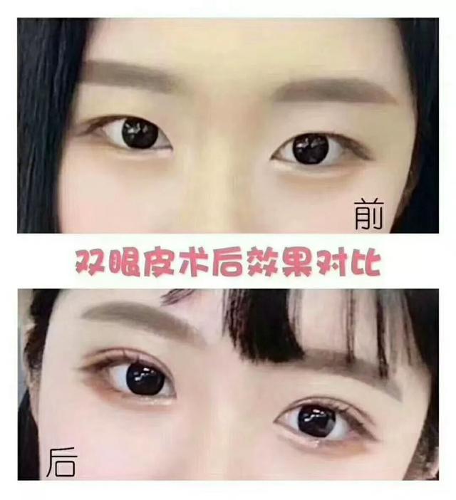 双眼皮手术后1-3天最尴尬的事,全切双眼皮出现大小眼是什么原因