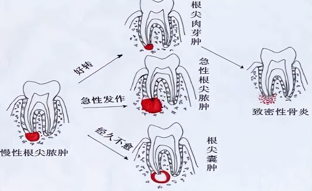 半夜出现牙疼和后背疼,牙出现大洞牙疼怎么办
