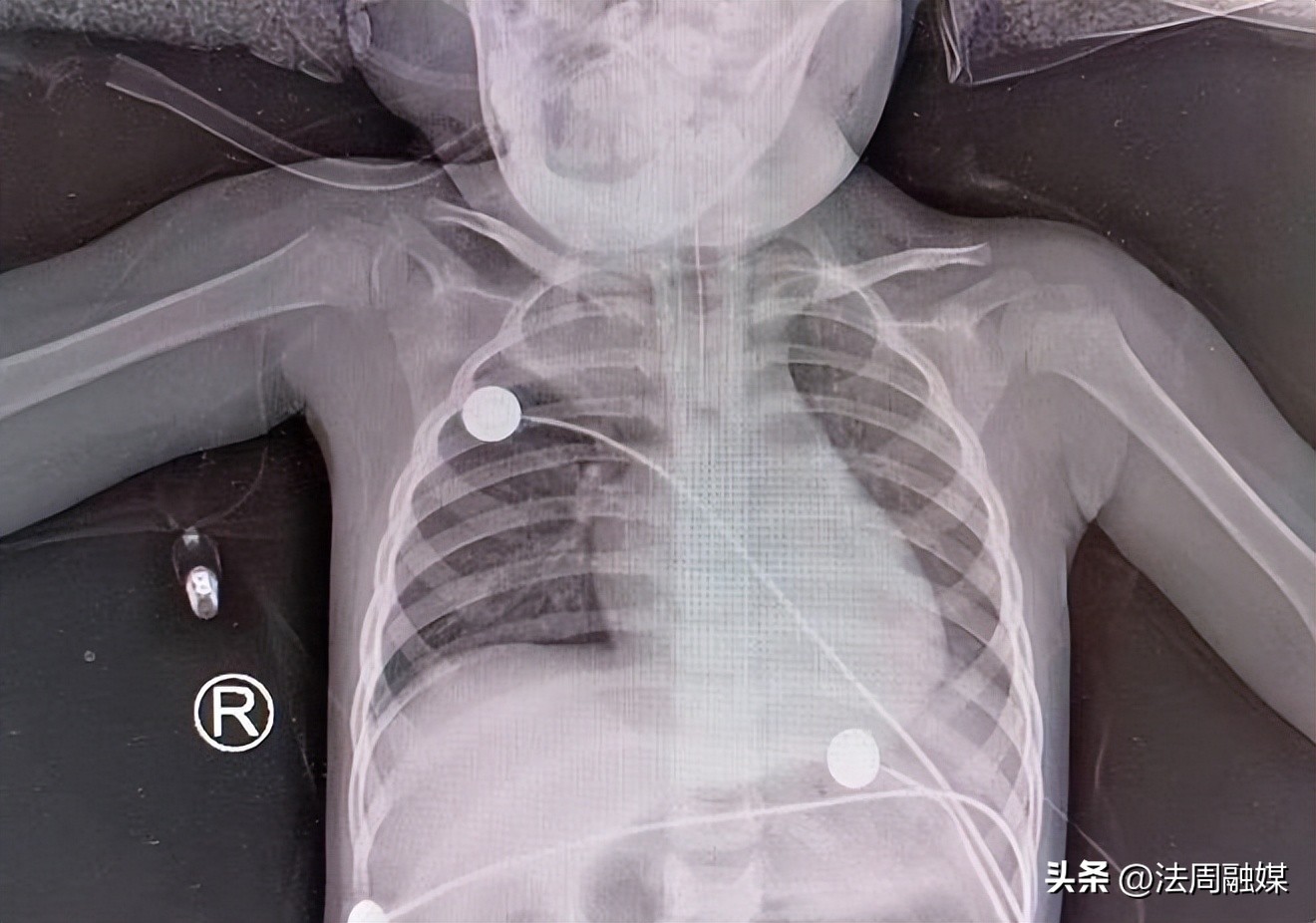 儿童吃花生卡气管死亡,小孩去吃坚果卡住医生接力急救