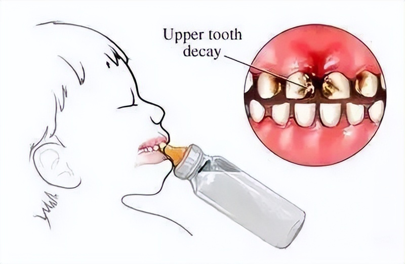 奶瓶龋要不要补,奶瓶龋宝宝以后会不会换牙
