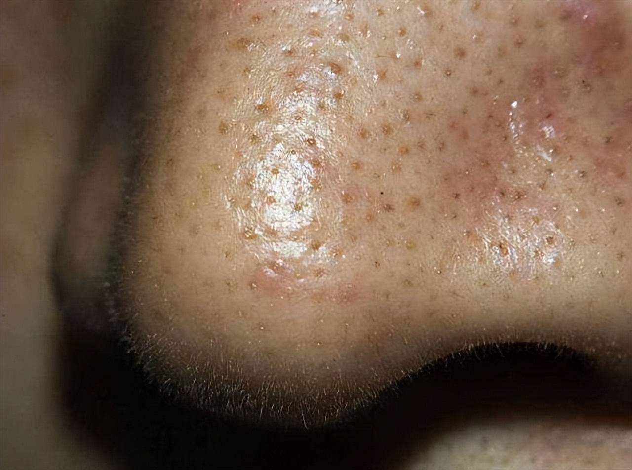 超微小气泡美容有用吗,美容院小气泡