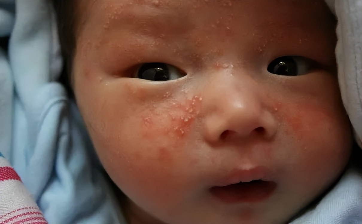 新生儿吐奶面部湿疹是过敏吗,宝宝身上起红点吐奶是怎么回事