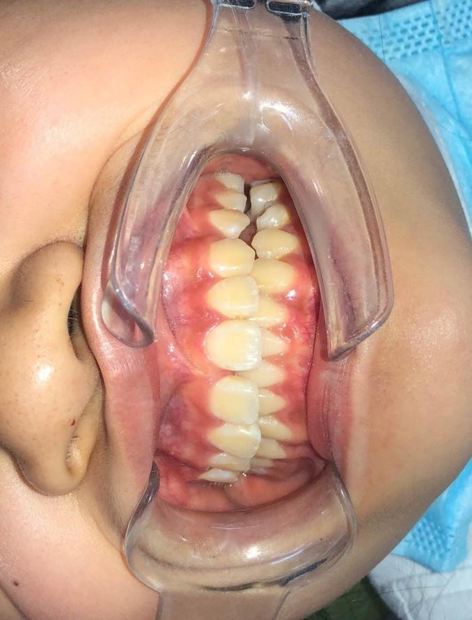 徐州儿童牙齿矫正牙齿不齐,大连口腔医院儿童牙齿矫正怎么样