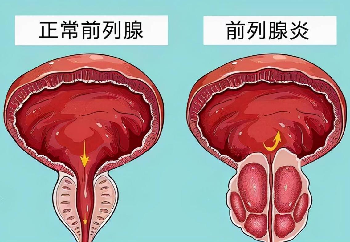 远离前列腺的最佳方法,前列腺最怕这六个坏习惯