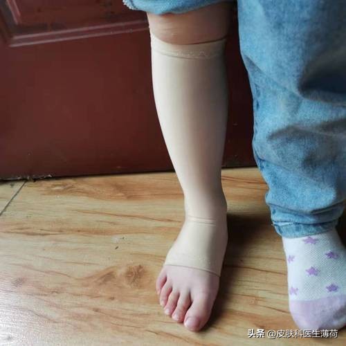 手术后的疤痕怎么去除颜色,手术后疤痕怎么去掉最有效