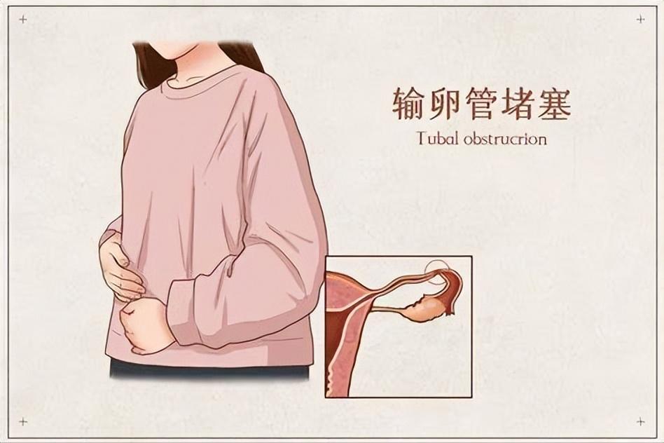 肝气郁结容易输卵管堵塞吗,为什么中医说输卵管堵就是肝病