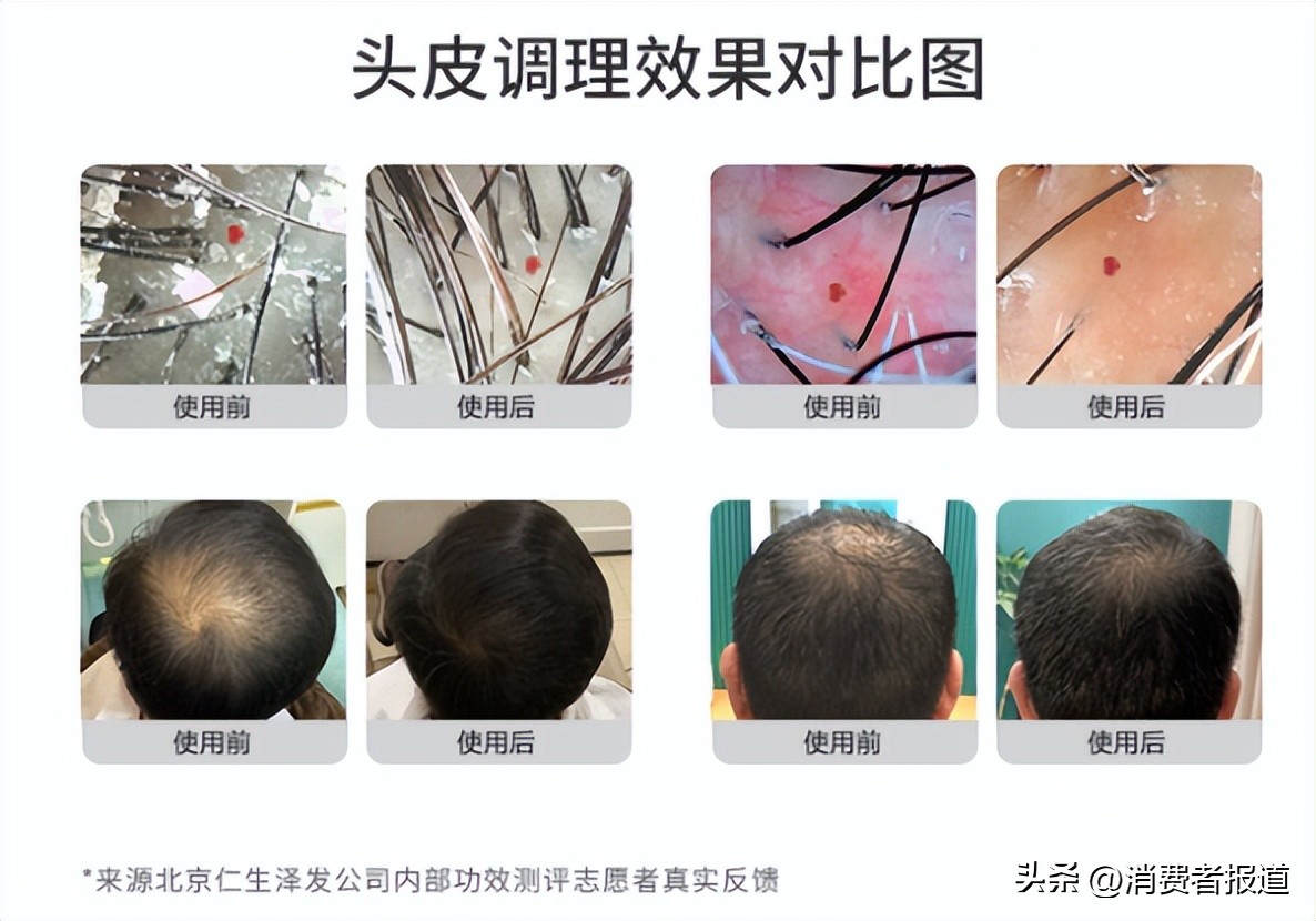 任泽平带货的“生发液”，备案仅为普通化妆品，被指玩“文字游戏”