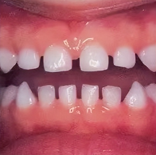 宝宝牙缝有点大这是好还是坏呢,为什么宝宝的牙缝很大