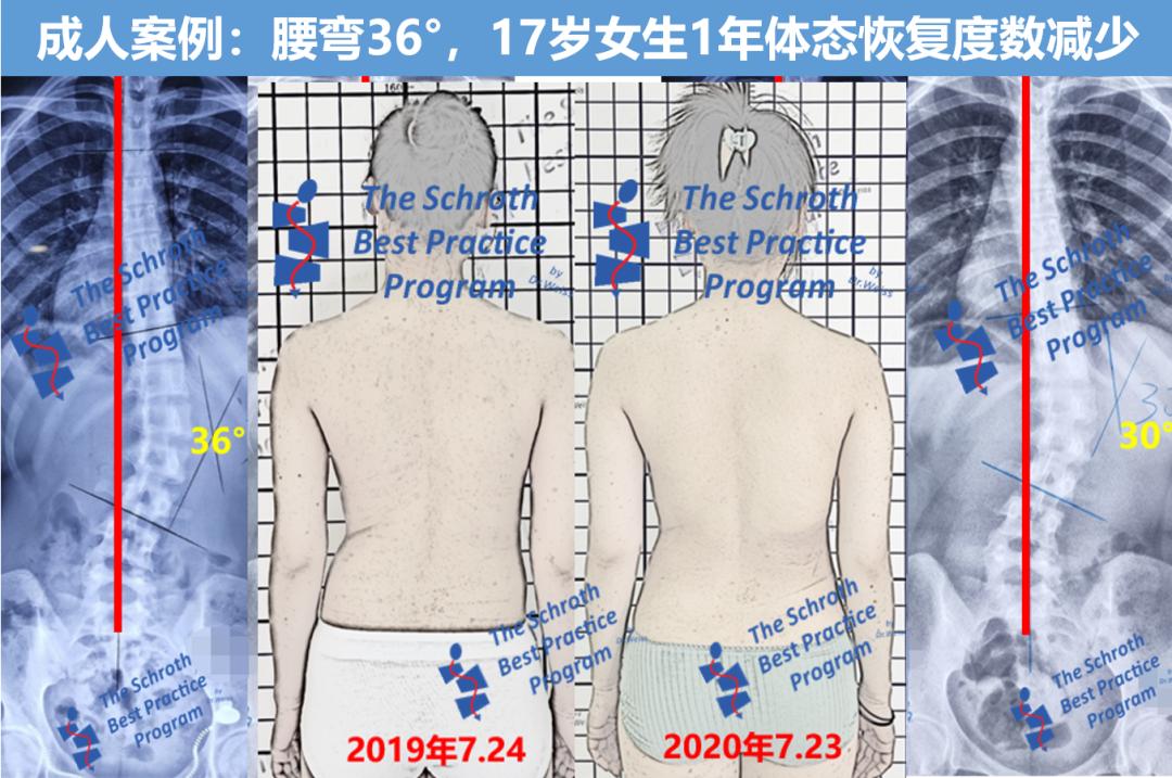 成人脊柱侧弯往哪弯,成年人脊柱侧弯怎么矫正