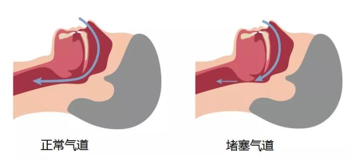 52岁男*爱性**打鼾，一晚上呼吸暂停多达400次，引发四肢抽搐