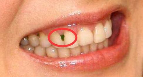 解决牙缝塞牙的办法,牙缝每天都塞牙怎么办