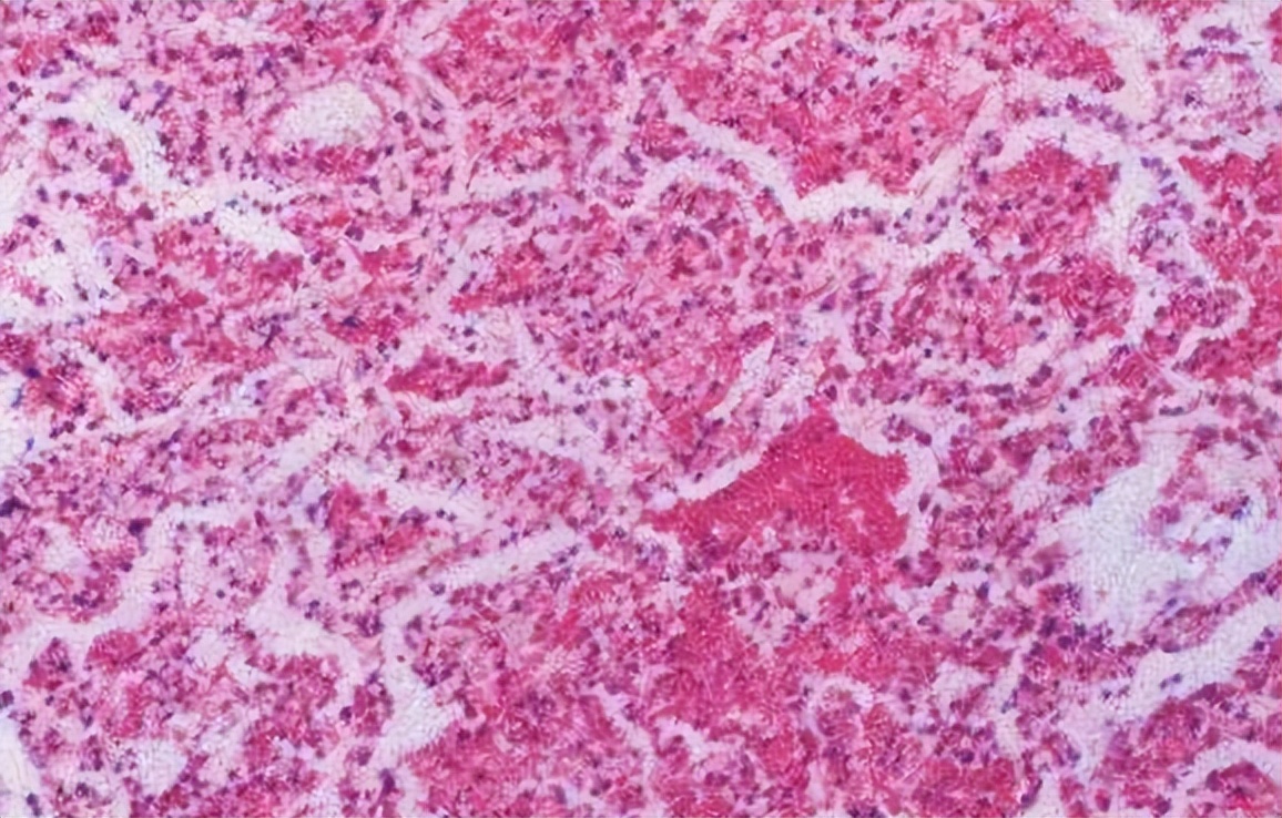 肺部黄痰与白痰区别,痰在肺部怎么形成的