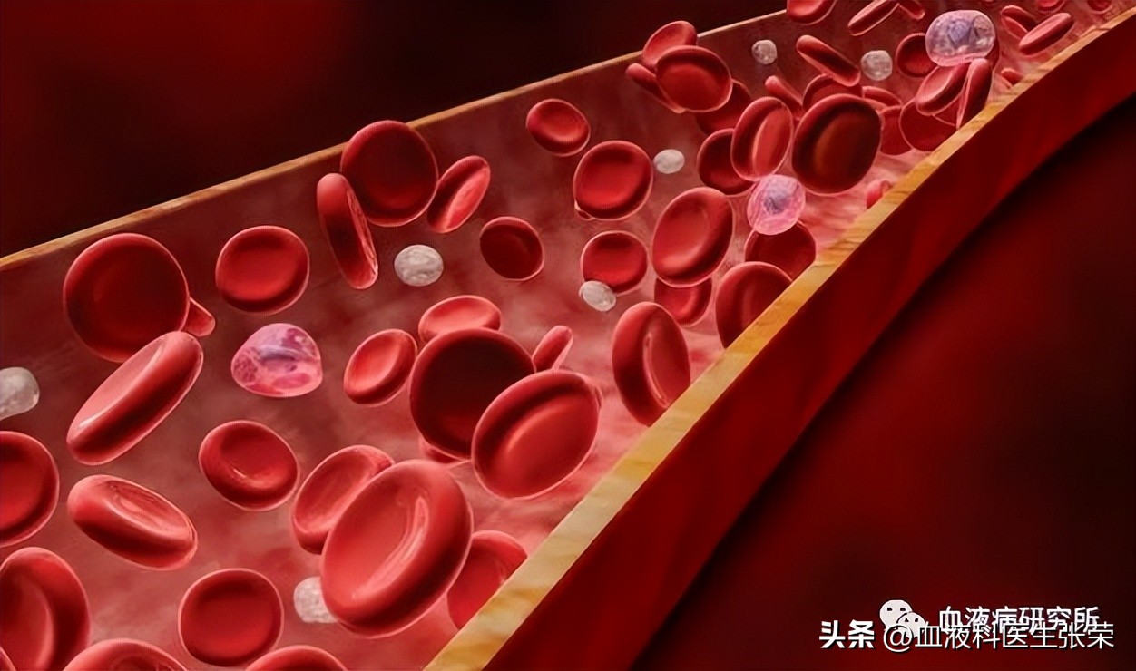 阵发性睡眠性血红蛋白尿治疗首选,阵发性睡眠性血红蛋白尿发病快吗