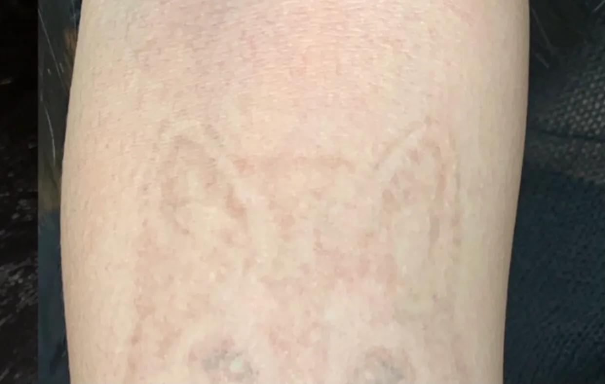 深圳清洗纹身哪家专业,推荐深圳专业洗纹身