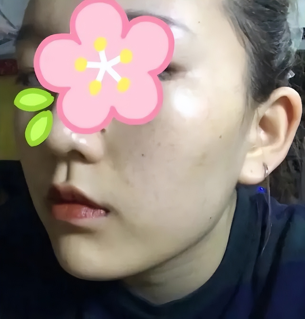 中医去脸上褐斑的经方,中医面部黑褐斑