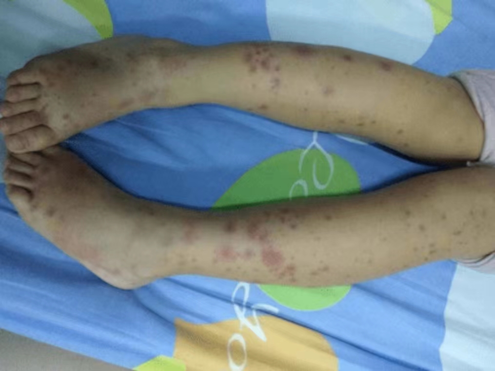 身上出现小红点，是血癌？医生：宝宝皮肤出现这3种异常，要当心