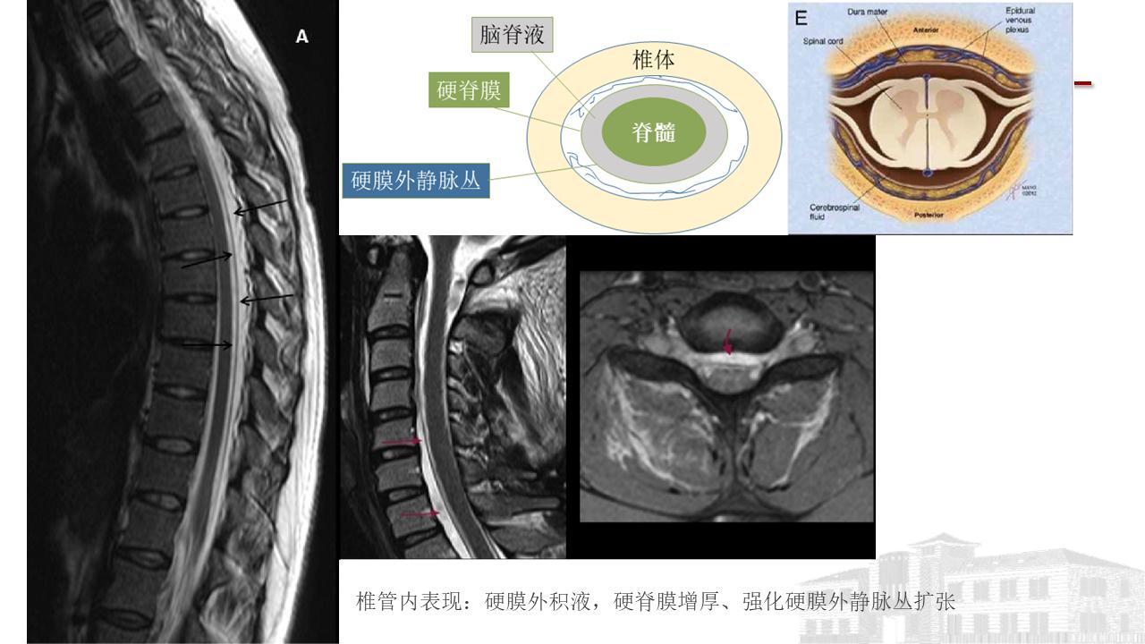 低颅压综合征耳闷,低颅压综合征吃什么药