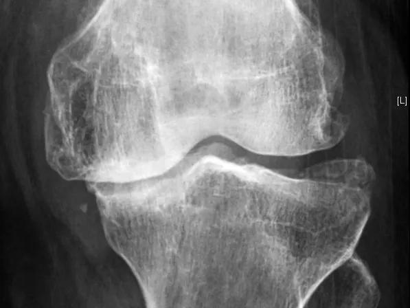 氨糖软骨素到底有没有用,氨糖用多了