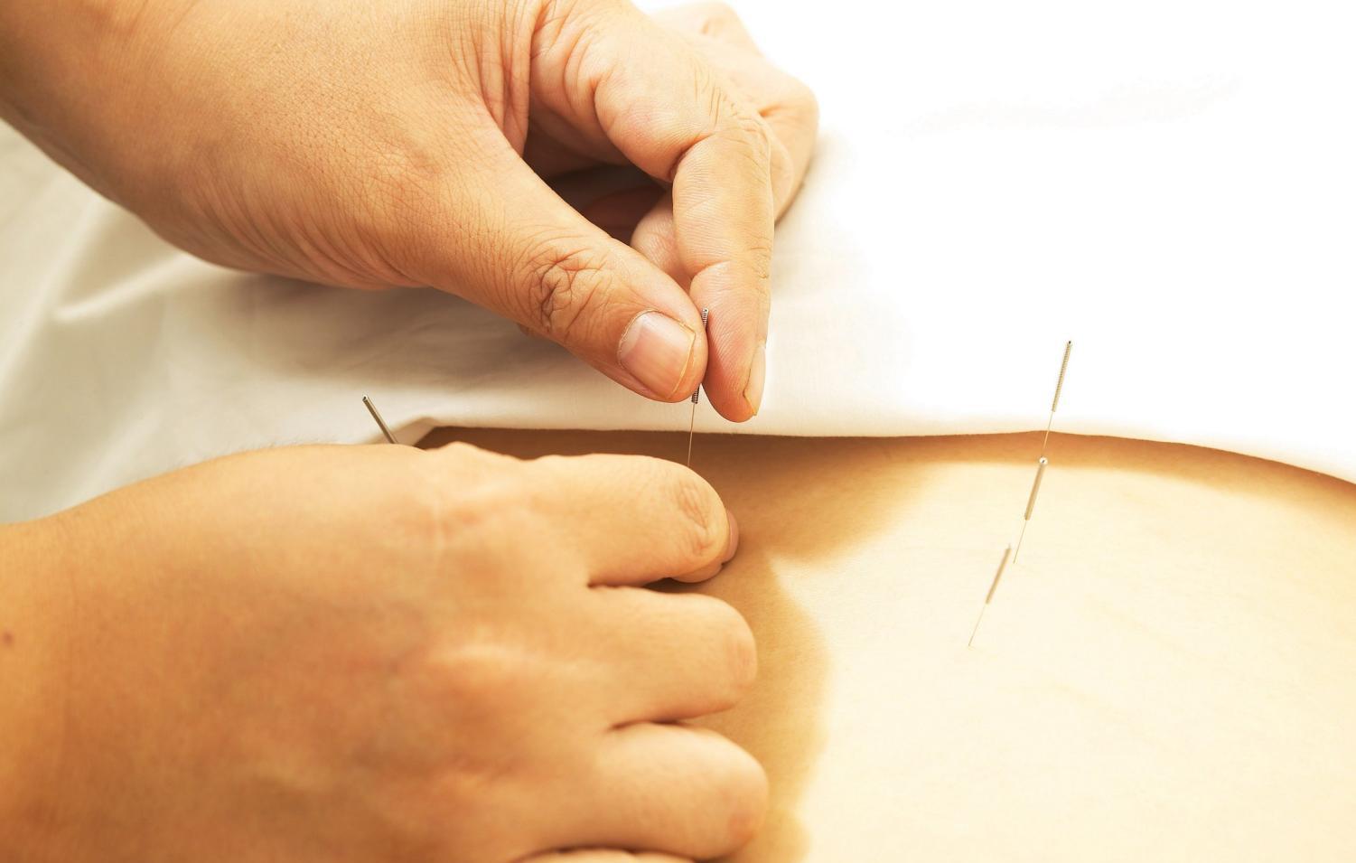 针灸临床经验选编精华,古法针灸临床治验