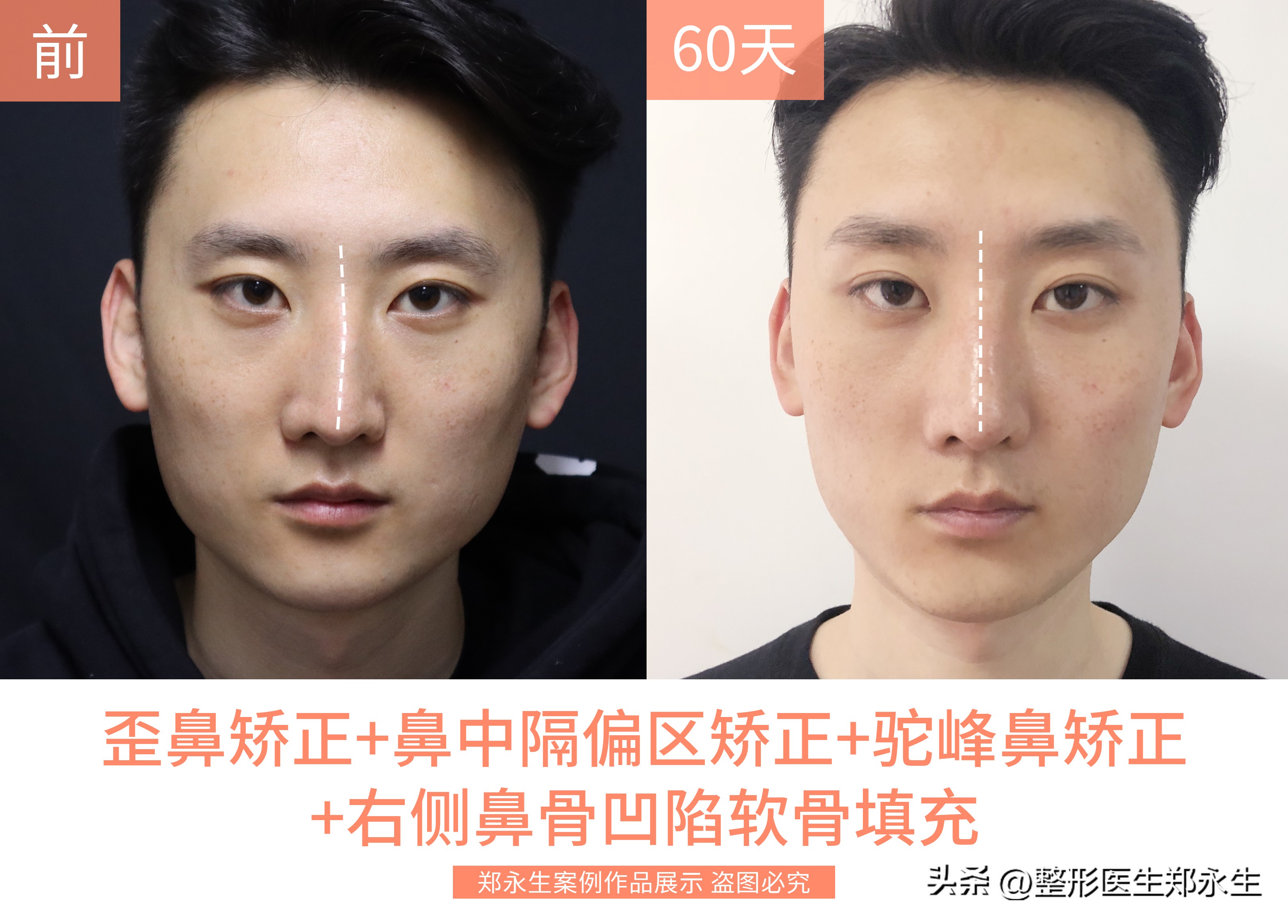 歪鼻子如何整形,歪鼻手术案例男