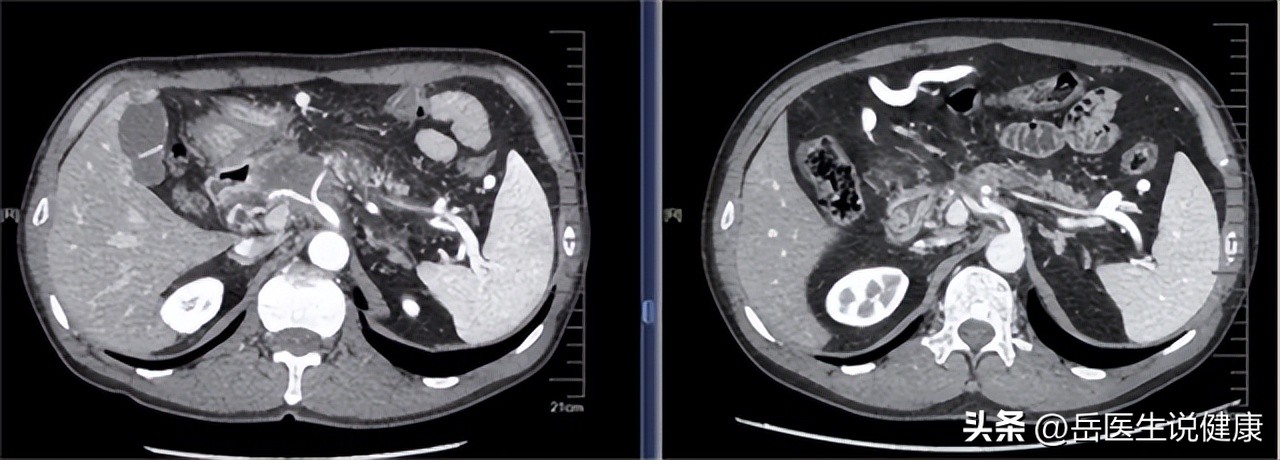 保护胰腺，就是守住我们的生命线，保护胰腺，要从这几件小事做起
