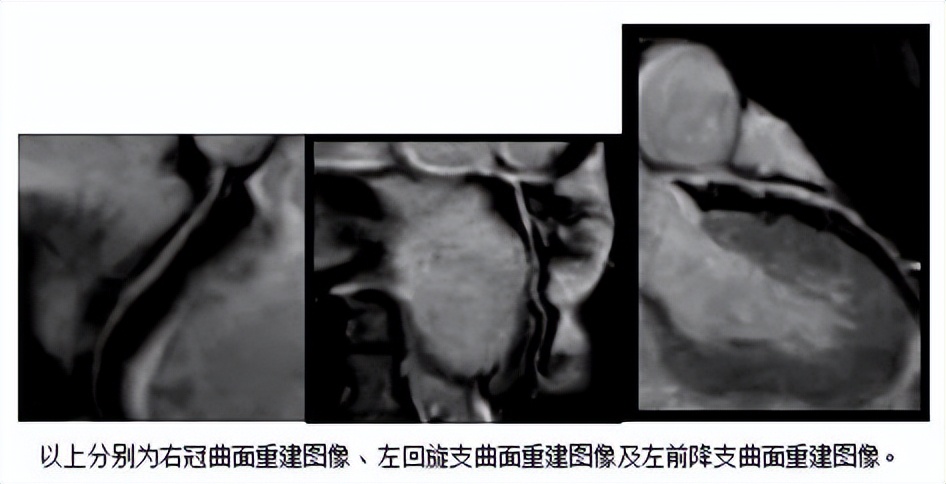 无创不打药！贵州医科大学附属医院完成贵州省首例冠脉磁共振血管造影