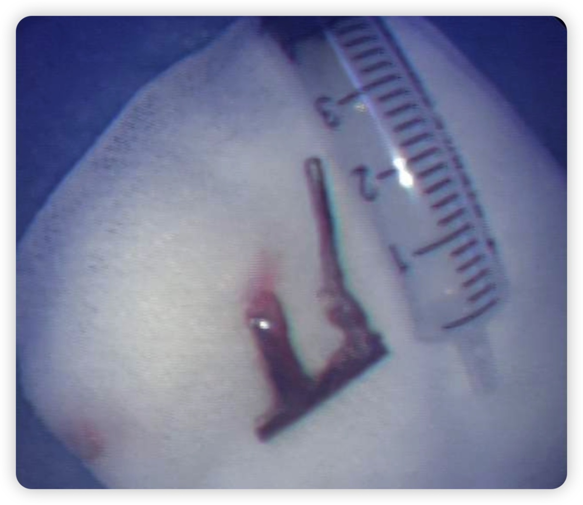 小儿做支气管镜能取出异物吗,医院支气管镜取出异物多少钱