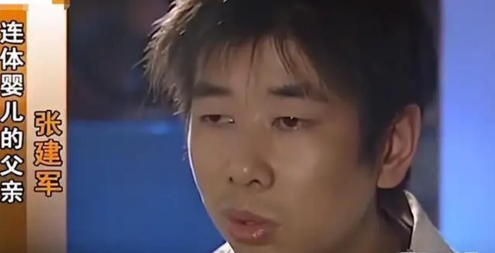 连体婴姐妹18年成功分离,连体婴姐妹成功分离后续