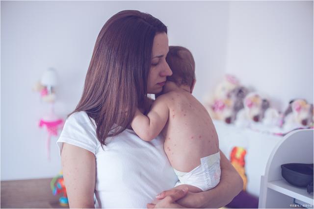 宝宝起风疹中医有妙招,风疹麻疹知识培训总结
