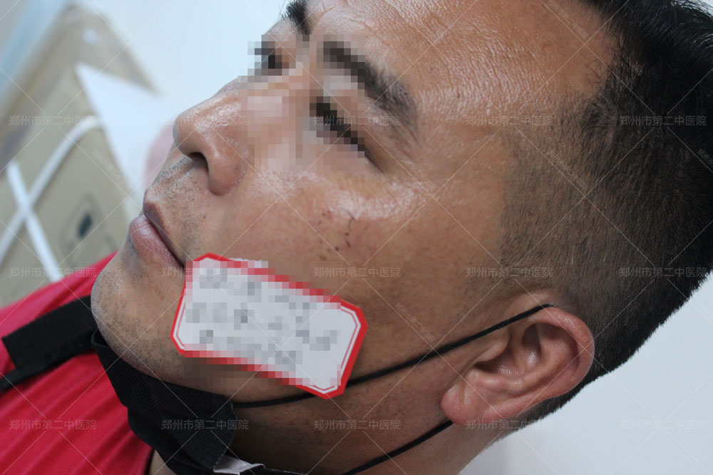 郑州市第二中医院：疤痕色素沉着怎么去除？