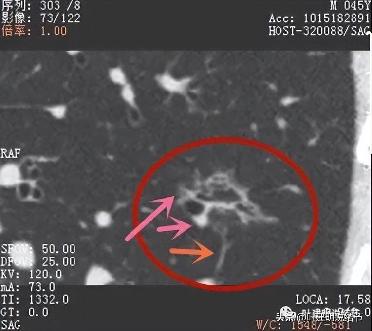 误诊肺纤维化,肺蜂窝状是癌吗