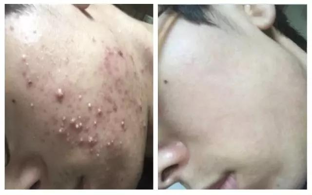 为什么做了激光痘坑还是没有好,为什么做了果酸痘坑越来越深