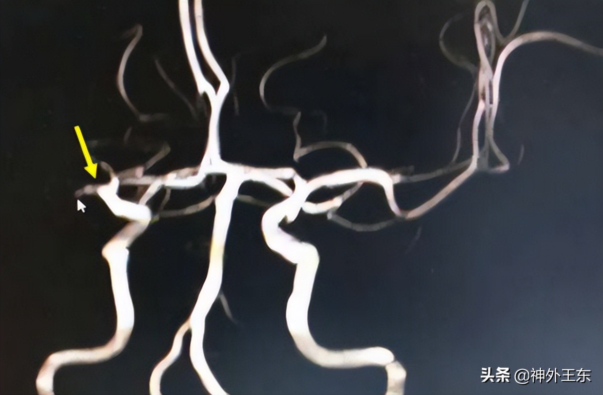 中医能治烟雾病吗,中医可以治疗脑血管烟雾病吗