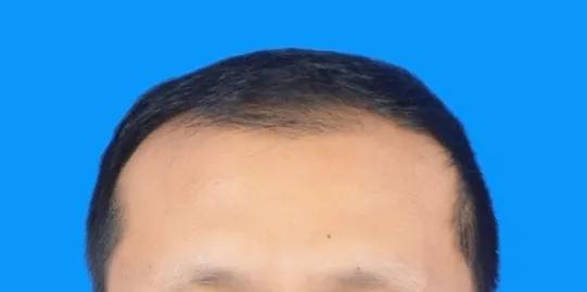 雄脱植发的亲身经历和感受,16000字讲述植发真实感受