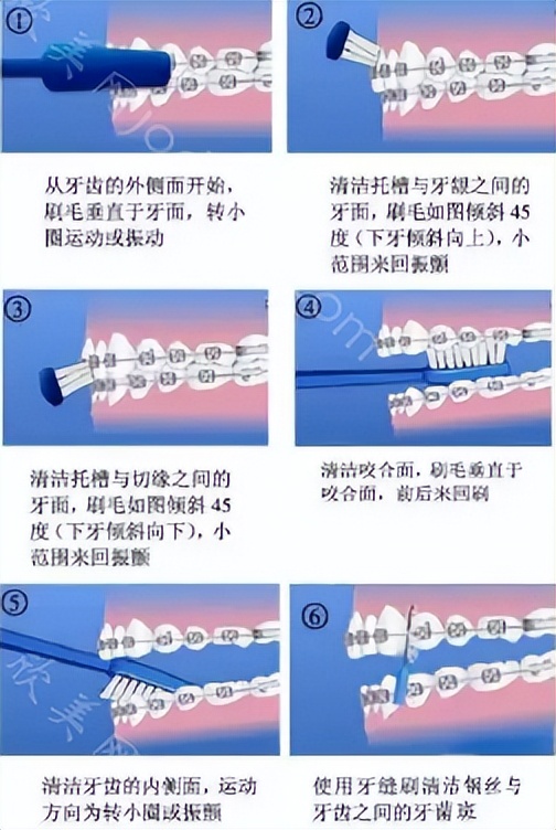 传统钢牙牙套佩戴过程,大牙戴牙套一般建议什么样的