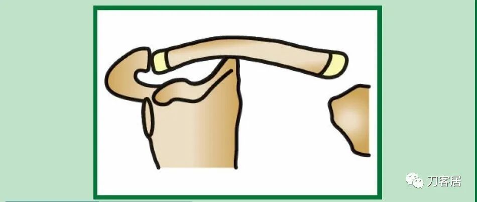 儿童锁骨骨折保守治疗的弊端,锁骨粉碎骨折错位不处理会愈合吗