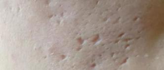 玛恩医生怎么样,玛恩医院祛疤痕靠谱吗