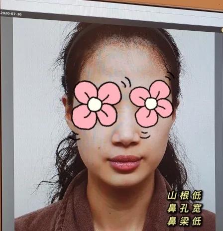 五官扁平脸怎么变高级感,扁平脸塌鼻子怎么改善