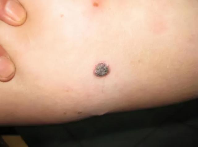 留意黑痣癌变五个重要形态,黑痣比较大才需要引起重视吗
