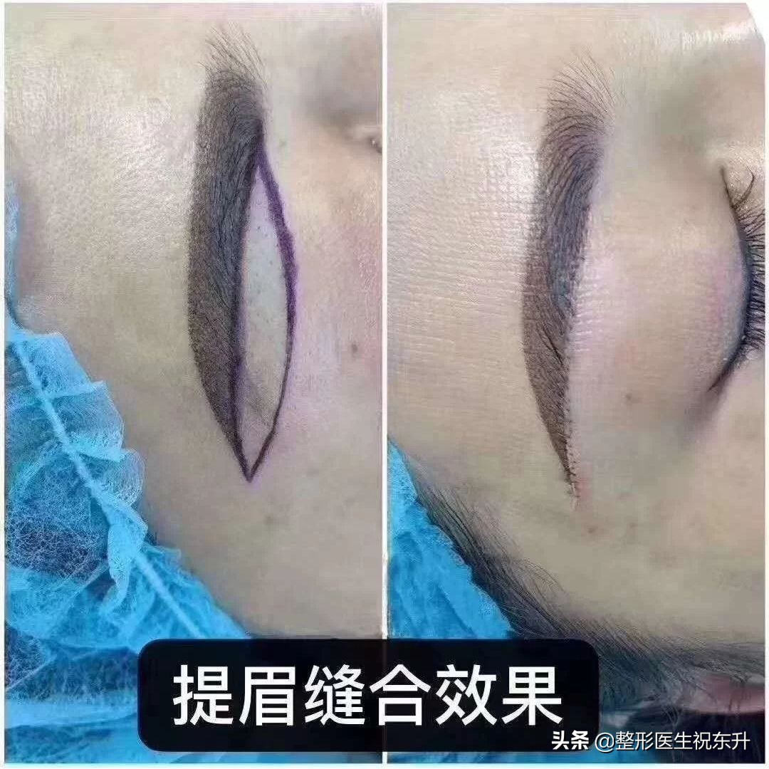 关于提眉手术的10个常见问题,提眉手术最简单的方式
