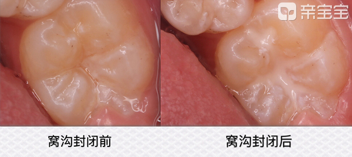 六龄齿龋坏怎么修复,孩子的六龄齿有个龋洞怎么办