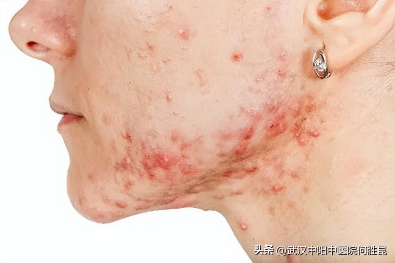 激光修复凸起疤痕疙瘩视频,疮留下的黑印怎么去除