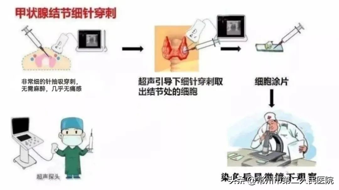 小针孔，用途多，漫画带你了解介入超声能做啥？