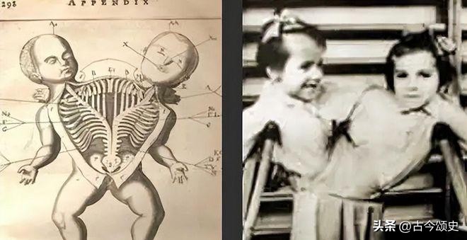 连体人结婚生子,连体人如何生子