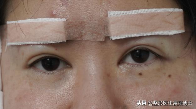 做完提眉后感觉很奇怪,做完提眉疼多久