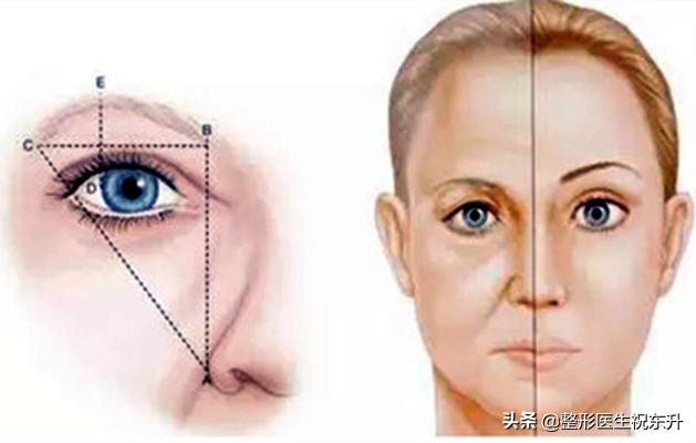 关于提眉手术的10个常见问题,提眉手术最简单的方式